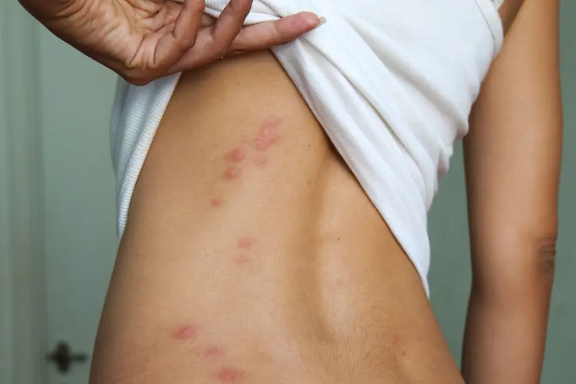 Insect bites on skin, a sign of biting insects in Johannesburg